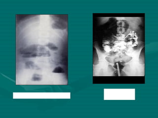 Obstrucción del intestino delgado vólvulus 