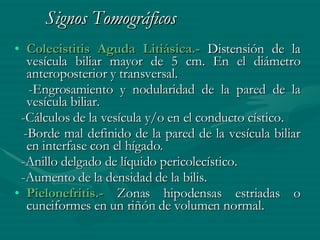 Signos Tomográficos Colecistitis Aguda Litiásica.-  Distensión de la vesícula biliar mayor de 5 cm. En el diámetro anteroposterior y transversal. -Engrosamiento y nodularidad de la pared de la vesícula biliar. -Cálculos de la vesícula y/o en el conducto cístico. -Borde mal definido de la pared de la vesícula biliar en interfase con el hígado. -Anillo delgado de líquido pericolecístico. -Aumento de la densidad de la bilis. Pielonefritis.-  Zonas hipodensas estriadas o cuneiformes en un riñón de volumen normal. 