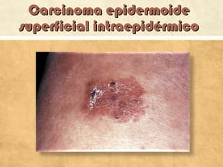 Carcinoma epidermoideCarcinoma epidermoide
superficial intraepidérmicosuperficial intraepidérmico
 