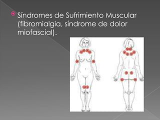  Síndromes de Sufrimiento Muscular
(fibromialgia, síndrome de dolor
miofascial).
 