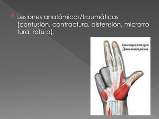  Lesiones anatómicas/traumáticas
(contusión, contractura, distensión, microrro
tura, rotura).
 