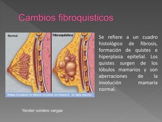Se refiere a un cuadro
histológico de fibrosis,
formación de quistes e
hiperplasia epitelial. Los
quistes surgen de los
lóbulos mamarios y son
aberraciones de la
involución mamaria
normal.
Yender cordero vargas
 