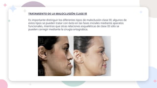 TRATAMIENTO DE LA MALOCLUSIÓN CLASE lll
Es importante distinguir los diferentes tipos de maloclusión clase III; algunos de
estos tipos se pueden tratar con éxito en las fases iniciales mediante aparatos
funcionales, mientras que otras relaciones esqueléticas de clase III sólo se
pueden corregir mediante la cirugía ortognática.
 