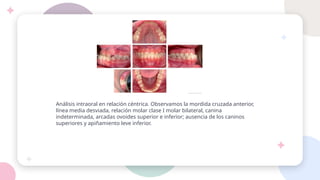Análisis intraoral en relación céntrica. Observamos la mordida cruzada anterior,
línea media desviada, relación molar clase I molar bilateral, canina
indeterminada, arcadas ovoides superior e inferior; ausencia de los caninos
superiores y apiñamiento leve inferior.
 