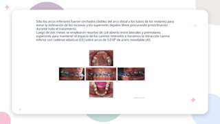 Sólo los arcos inferiores fueron cinchados (doblez del arco distal a los tubos de los molares) para
evitar la inclinación de los incisivos y los superiores dejados libres procurando proinclinación
durante todo el tratamiento.
Luego de dos meses se emplearon resortes de coil abierto entre laterales y premolares
superiores para mantener el espacio de los caninos retenidos e iniciamos la retracción canina
inferior con cadenas elásticas (CE) sobre arcos de 0.018” de acero inoxidable (AI)
 