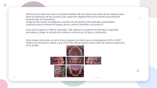 Sólo los arcos inferiores fueron cinchados (doblez del arco distal a los tubos de los molares) para
evitar la inclinación de los incisivos y los superiores dejados libres procurando proinclinación
durante todo el tratamiento.
Luego de dos meses se emplearon resortes de coil abierto entre laterales y premolares
superiores para mantener el espacio de los caninos retenidos e iniciamos la
Arcos de AI superior e inferior redondos, coils abiertos en superior de laterales a segundos
premolares y abajo se activaba de molares a caninos con CE para su retracción.
Ocho meses más tarde, se retiró el arco lingual y se colocó arcos rectangulares 0.019 x 0.025”
inferior de nitinol para nivelar y arco 0.014” de nitinol superior para incluir los caninos superiores
en la arcada.
 