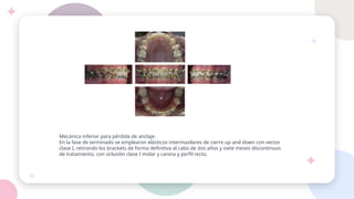 Mecánica inferior para pérdida de anclaje.
En la fase de terminado se emplearon elásticos intermaxilares de cierre up and down con vector
clase I, retirando los brackets de forma definitiva al cabo de dos años y siete meses discontinuos
de tratamiento, con oclusión clase I molar y canina y perfil recto.
 