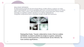 RESULTADOS OBTENIDOS
Se obtuvo buena proyección de tercio facial inferior, un labio inferior y superior con mejor
soporte dentoalveolar, una sonrisa agradable, perfil recto, armonía facial, labios en un mismo
plano, clase I molar y canina, sobre mordida horizontal y vertical adecuada y líneas medias
centradas, sin significar cambios radicales en sus valores cefalométricos
Fotografías comparativas extra e intraorales iniciales y finales del tratamiento.
Radiografías finales. Trazado cefalométrico inicial y final con análisis
de Ricketts; se observó pérdida de anclaje en superior, inclinación
de incisivos anterosuperiores y retroinclinación de los inferiores. No
hubo cambios significativos.
 