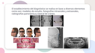 El establecimiento del diagnóstico se realiza en base a diversos elementos
como son: modelos de estudio, fotografías intraorales y extraorales,
radiografías panorámica y lateral de cráneo.
 