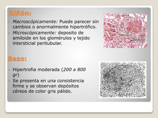 Riñón:
 Macroscópicamente: Puede parecer sin
cambios o anormalmente hipertrófico.
 Microscópicamente: deposito de
amiloide en los glomérulos y tejido
intersticial peritubular.
Bazo:
 Hipertrofia moderada (200 a 800
gr)
 Se presenta en una consistencia
firme y se observan depósitos
céreos de color gris pálido.
 