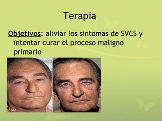 Terapia
Objetivos: aliviar los sintomas de SVCS y
 intentar curar el proceso maligno
 primario
 