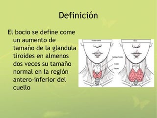 Definición
El bocio se define come
  un aumento de
  tamaño de la glandula
  tiroides en almenos
  dos veces su tamaño
  normal en la región
  antero-inferior del
  cuello
 
