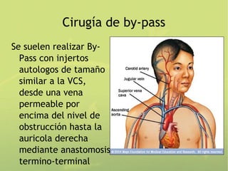 Cirugía de by-pass
Se suelen realizar By-
  Pass con injertos
  autologos de tamaño
  similar a la VCS,
  desde una vena
  permeable por
  encima del nivel de
  obstrucción hasta la
  auricola derecha
  mediante anastomosis
  termino-terminal
 
