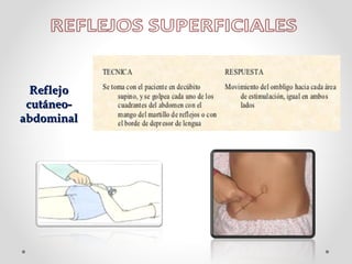 Reflejo
cutáneoabdominal

 