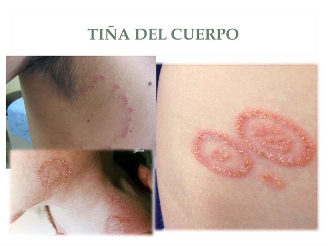 Enfermedades Infecciosas de Piel