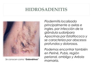 HIDROSADENITIS
Piodermitis localizada
principalmente a axilas e
ingles, por infección de la
glándula sudorípara
Apocrinas por Estafilococo y
se caracteriza por abscesos
profundos y dolorosos.
Podemos encontrar también
en Periné, Pubis, región
perianal, ombligo y Aréola
mamaria.
Se conocen como “Golondrinos”
 