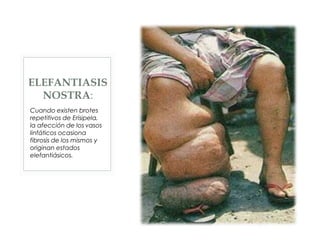 ELEFANTIASIS
NOSTRA:
Cuando existen brotes
repetitivos de Erisipela,
la afección de los vasos
linfáticos ocasiona
fibrosis de los mismos y
originan estados
elefantiásicos.
 