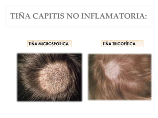 TIÑA CAPITIS NO INFLAMATORIA:
TIÑA MICROSPORICA TIÑA TRICOFÍTICA
 