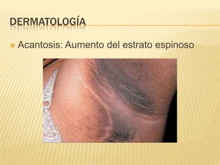 DERMATOLOGÍA

   Acantosis: Aumento del estrato espinoso
 
