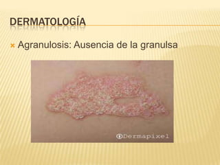 DERMATOLOGÍA

   Agranulosis: Ausencia de la granulsa
 