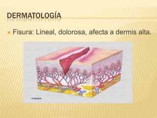 DERMATOLOGÍA

   Fisura: Lineal, dolorosa, afecta a dermis alta.
 