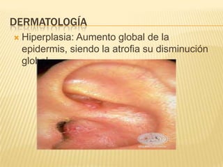 DERMATOLOGÍA
   Hiperplasia: Aumento global de la
    epidermis, siendo la atrofia su disminución
    global.
 