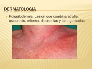DERMATOLOGÍA
   Poiquilodermia: Lesion que combina atrofia,
    esclerosis, eritema, discromias y talangectasias
 
