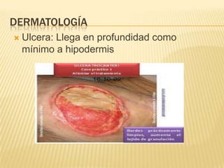 DERMATOLOGÍA
   Ulcera: Llega en profundidad como
    mínimo a hipodermis
 