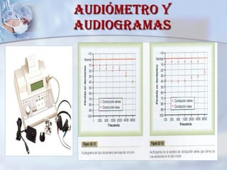 Audiómetro y audiogramas