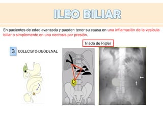 Triada Rigeler Colelitiasis, coledocolitiasis, colecistectomia | PDF
