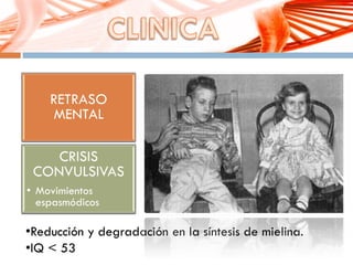 RETRASO
MENTAL
CRISIS
CONVULSIVAS
• Movimientos
espasmódicos
•Reducción y degradación en la síntesis de mielina.
•IQ < 53
 