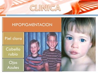 HIPOPIGMENTACION
Piel clara
Cabello
rubio
Ojos
Azules
 