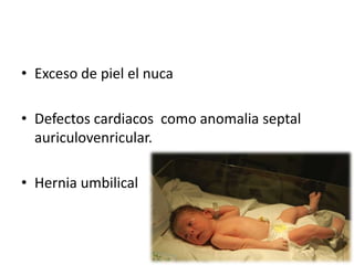 • Exceso de piel el nuca

• Defectos cardiacos como anomalia septal
  auriculovenricular.

• Hernia umbilical
 