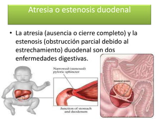 Atresia o estenosis duodenal

• La atresia (ausencia o cierre completo) y la
  estenosis (obstrucción parcial debido al
  estrechamiento) duodenal son dos
  enfermedades digestivas.
 