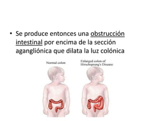 • Se produce entonces una obstrucción
  intestinal por encima de la sección
  agangliónica que dilata la luz colónica
 