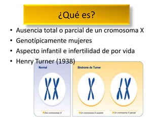 ¿Qué es?
•   Ausencia total o parcial de un cromosoma X
•   Genotípicamente mujeres
•   Aspecto infantil e infertilidad de por vida
•   Henry Turner (1938)
 