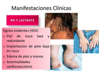 Manifestaciones Clínicas


Signos evidentes (45X)
o Piel de nuca laxa y
   redundante
o Implantacion de pelo baja
   en nuca
o Edema de pies y manos
o Anormalidades
   cardiovasculares
 