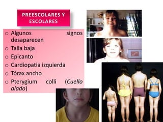o Algunos               signos
  desaparecen
o Talla baja
o Epicanto
o Cardiopatia izquierda
o Tórax ancho
o Pterygium colli (Cuello
  alado)
 