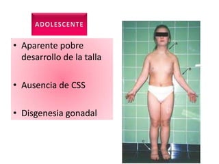 • Aparente pobre
  desarrollo de la talla

• Ausencia de CSS

• Disgenesia gonadal
 