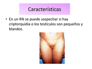 Características
• En un RN se puede sospechar si hay
  criptorquidia o los testículos son pequeños y
  blandos.
 