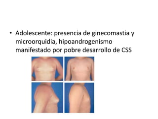 • Adolescente: presencia de ginecomastia y
  microorquidia, hipoandrogenismo
  manifestado por pobre desarrollo de CSS
 