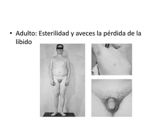 • Adulto: Esterilidad y aveces la pérdida de la
  libido
 