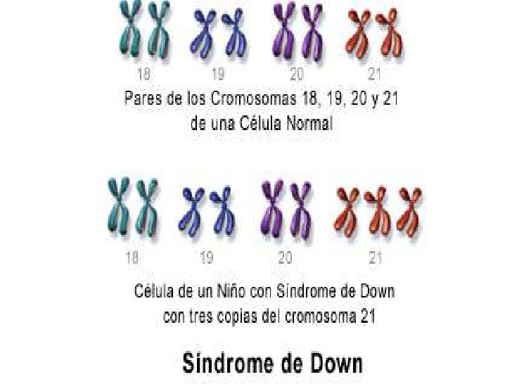Genetica sindrome de down