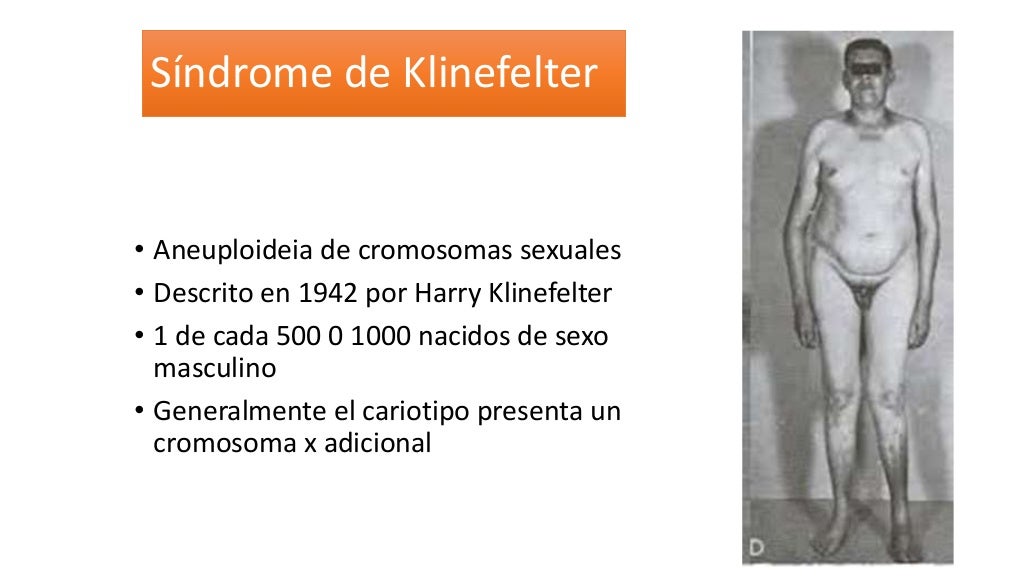 SÍNDROME DOWN, KLINEFELTER, TURNER