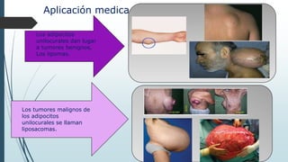 Aplicación medica
Los adipocitos
unilocurales dan lugar
a tumores benignos,
Los lipomas.
Los tumores malignos de
los adipocitos
unilocurales se llaman
liposacomas.
 