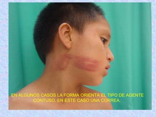 EN ALGUNOS CASOS LA FORMA ORIENTA EL TIPO DE AGENTE
CONTUSO, EN ESTE CASO UNA CORREA.
 