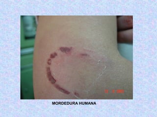 MORDEDURA HUMANA
 