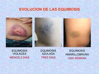 EVOLUCION DE LAS EQUIMOSIS
EQUIMOSIS
VIOLACEA
MENOS 2 DIAS
EQUIMOSIS
AZULADA
TRES DIAS
EQUIMOSIS
AMARILLOBRUNA
UNA SEMANA
 