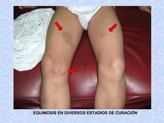 EQUIMOSIS EN DIVERSOS ESTADIOS DE CURACIÓN
 