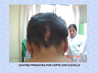 CICATRIZ PRODUCIDA POR CORTE CON CUCHILLO
 